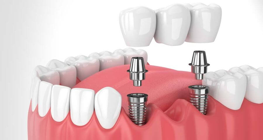 implanturi dentare Timisoara