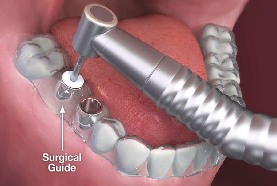implanturi dentare cu ghid chirurgical timisoara