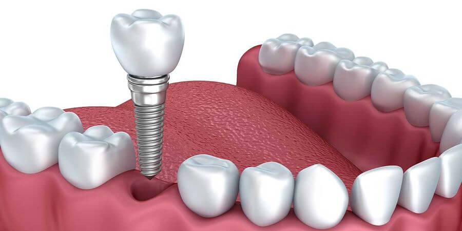 implanturi dentare Timisoara