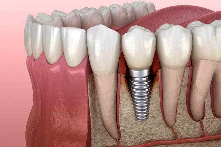 clinica dentara Timisoara, implant dentar Timisoara