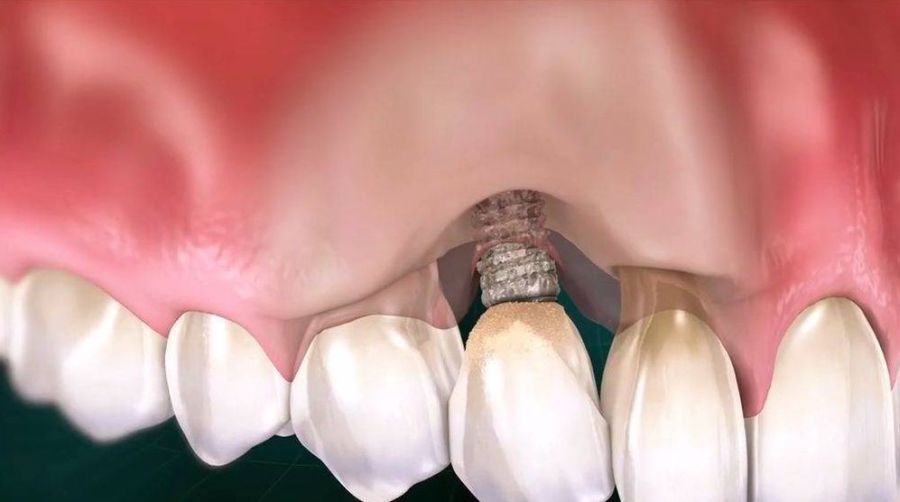tratamente dentare Timisoara, implant dentar rapid Timisoara