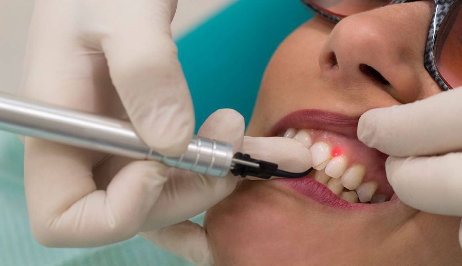 decontaminare parodontală cu laser dentar Timisoara