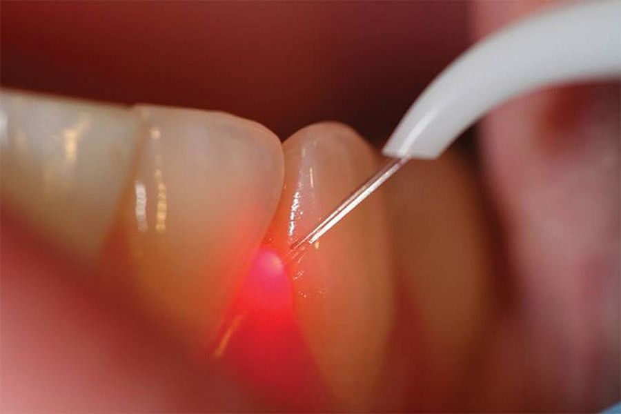 laser dentar, laser stomatologic Timisoara