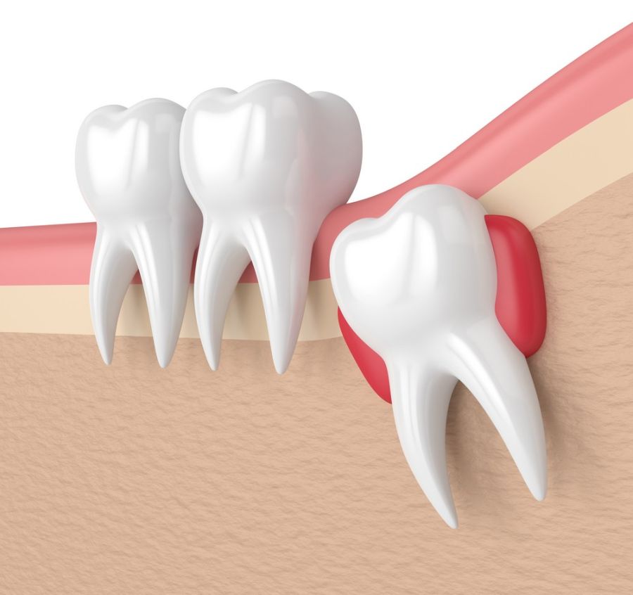 Când este necesară extracția dentară?