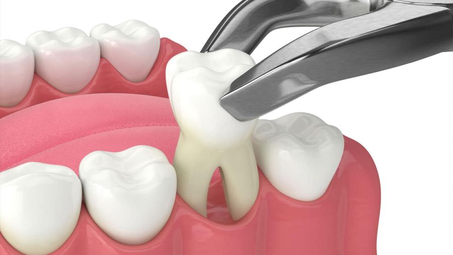 Când este necesară extracția dentară?
