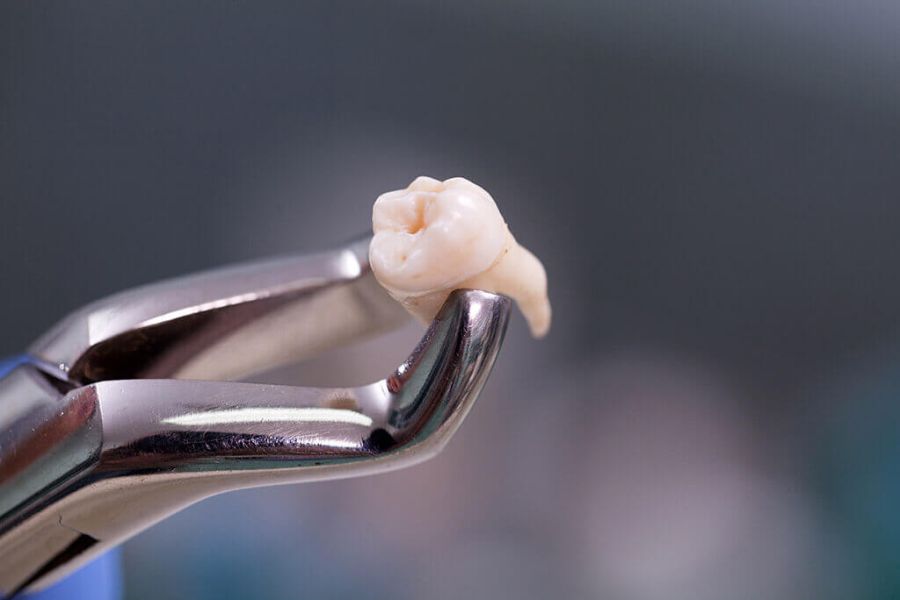 Când este necesară extracția dentară?