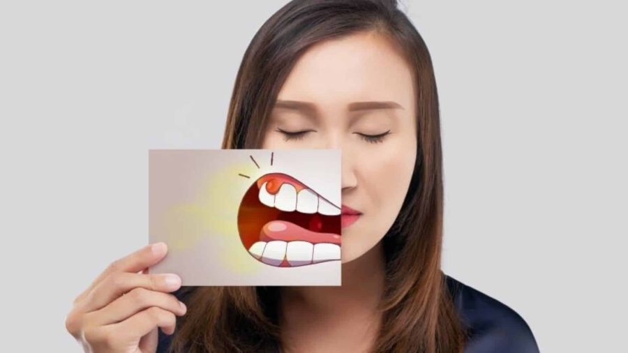diferența dintre gingivită și parodontită