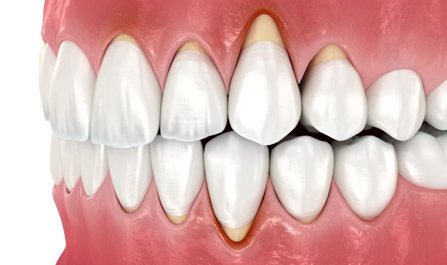 diferența dintre gingivită și parodontită