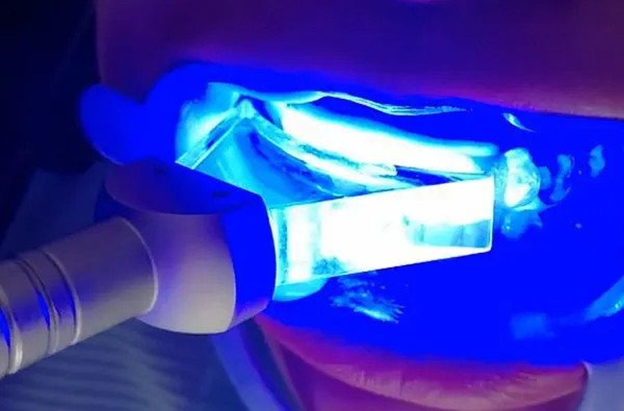Albire dentară cu LASER stomatologic