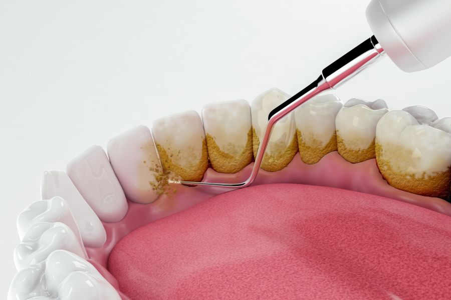 Profilaxie dentară clinica dentist Timisoara