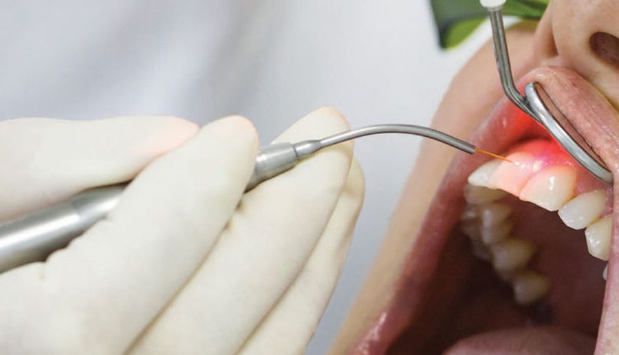 Terapia durerii laser dentar in Timisoara