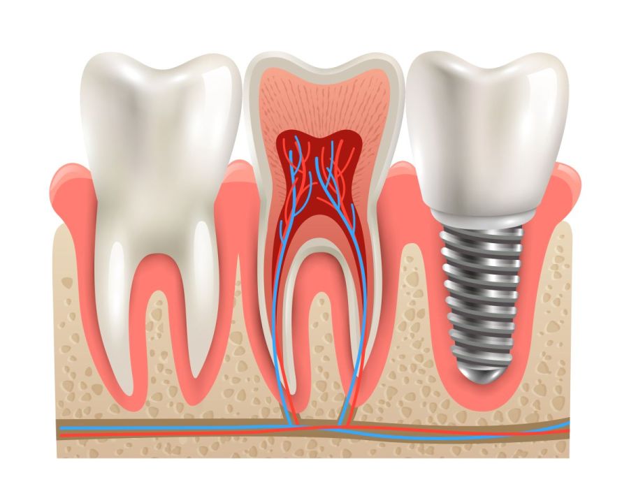 Când este recomandat implantul dentar?