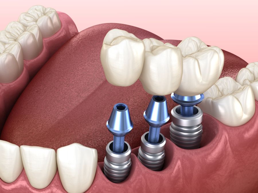 Când este recomandat implantul dentar?