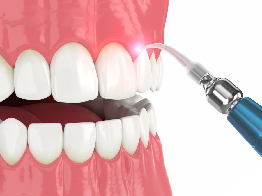 decontaminare parodontală cu laser dentar