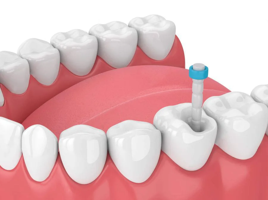 Tratament endodontic la clinica Perio Care din Timisoara