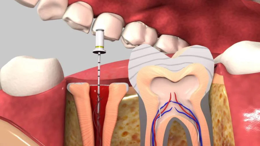 Tratament endodontic la clinica Perio Care din Timisoara