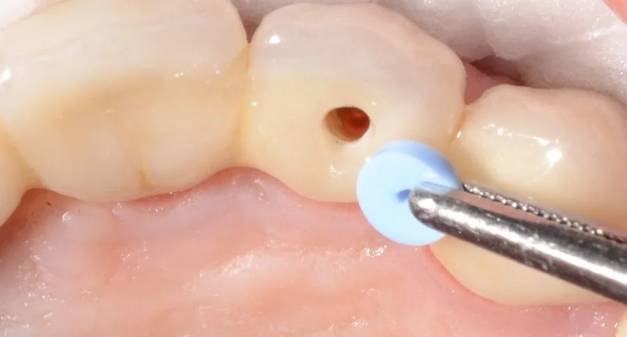 Tratament endodontic la clinica Perio Care din Timisoara