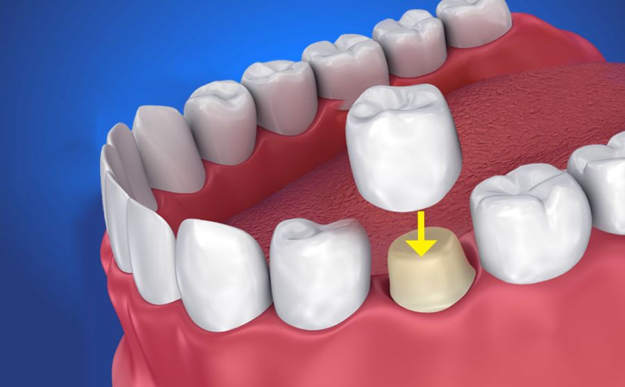 Tipuri de coroane dentare estetica dentara in Timisoara