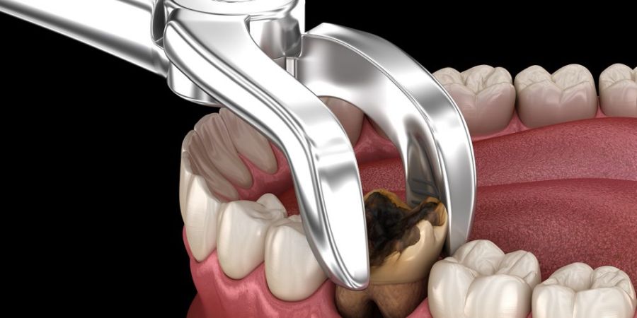 Ce trebuie să știi despre extracție dentară