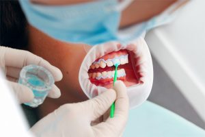 despre albirea dentară laser Timisoara
