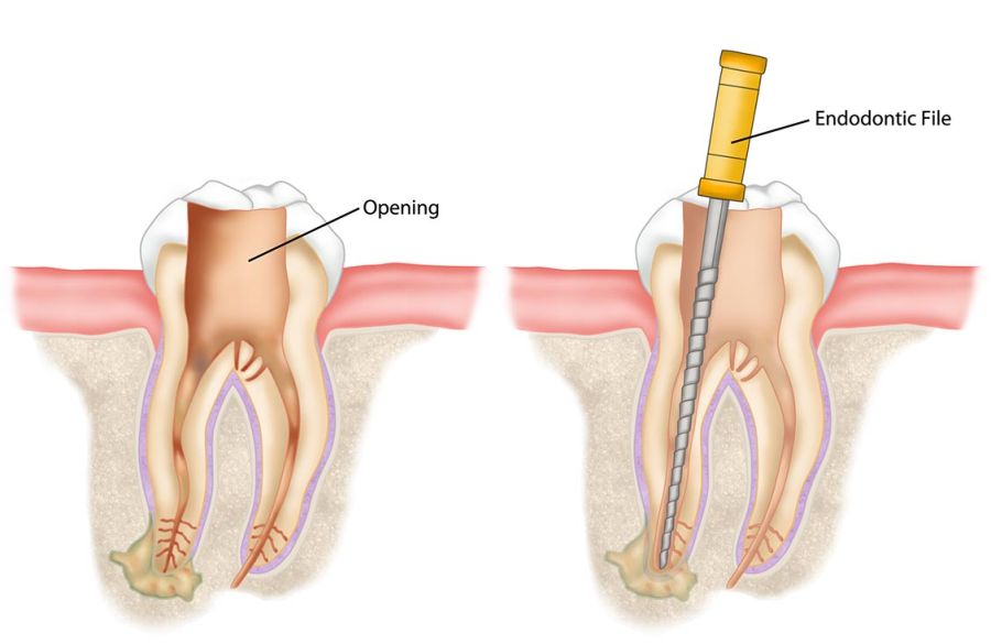 Cât durează un tratament endodontic in Timisoara