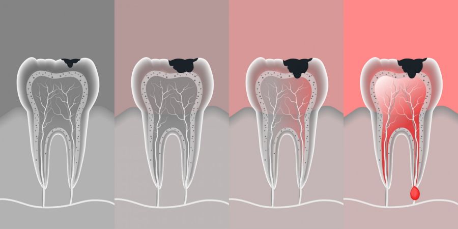 Cât durează un tratament endodontic in Timisoara