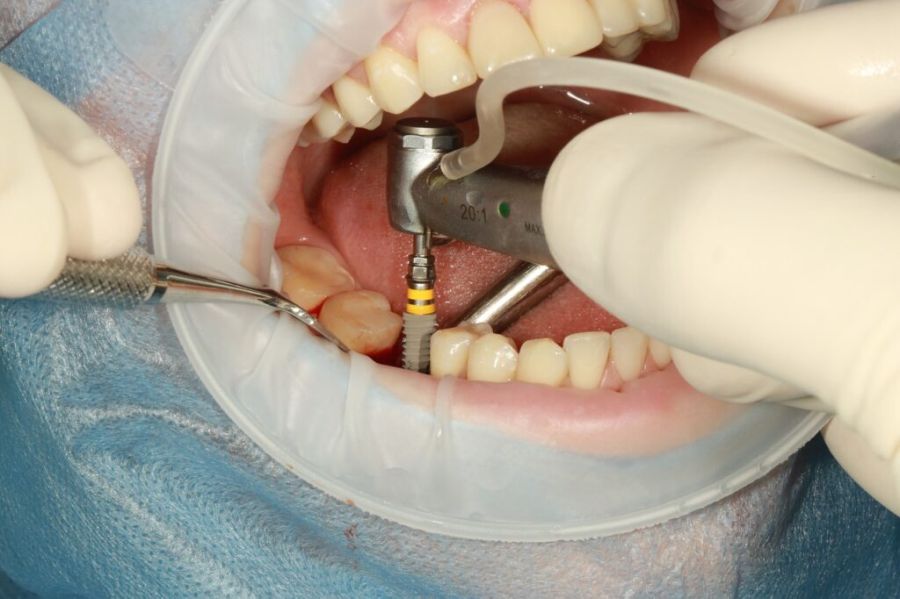 Avantaje tratament implant dentar Timișoara
