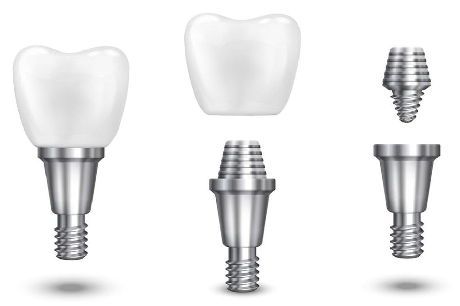 Avantaje tratament implant dentar Timișoara