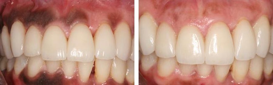 Depigmentarea gingivală cu laser Timisoara