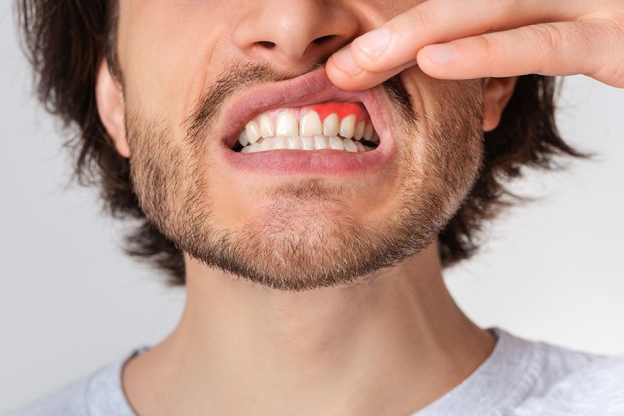 Cum prevenim problemele gingivale in Timisoara
