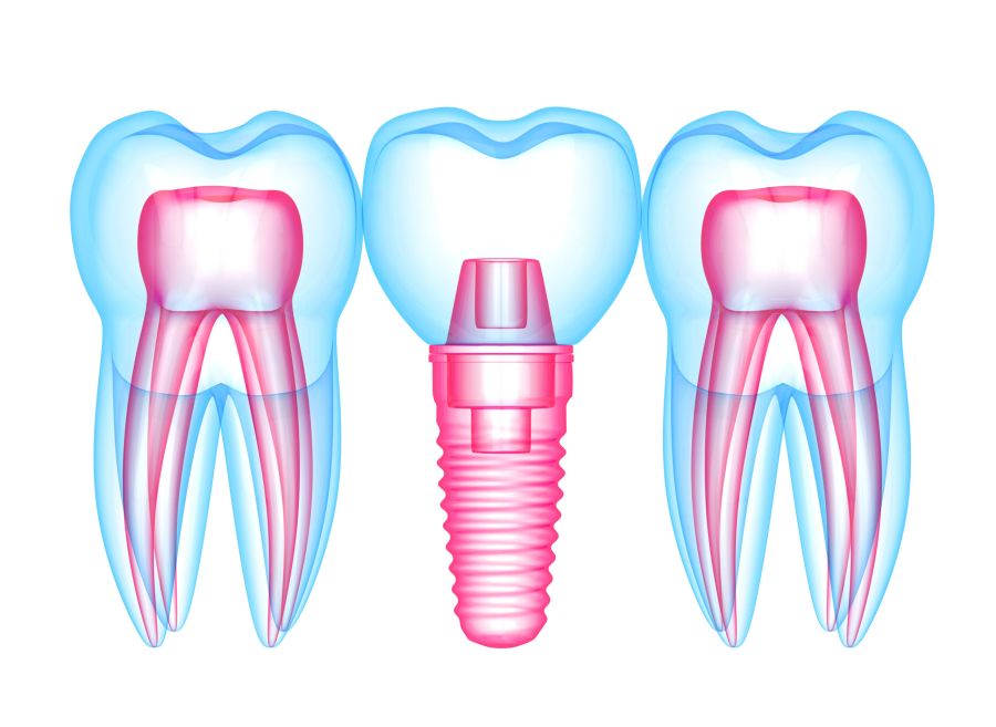 Implant dentar pret Timisoara dinti ficsi Timisoara