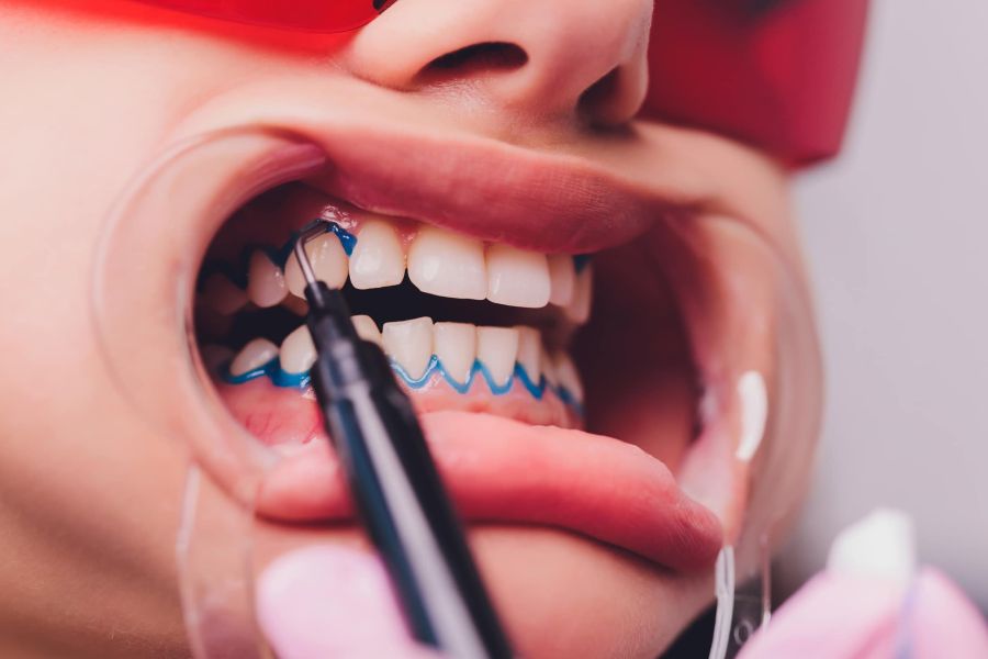 Albirea dentară cu laser in Timisoara