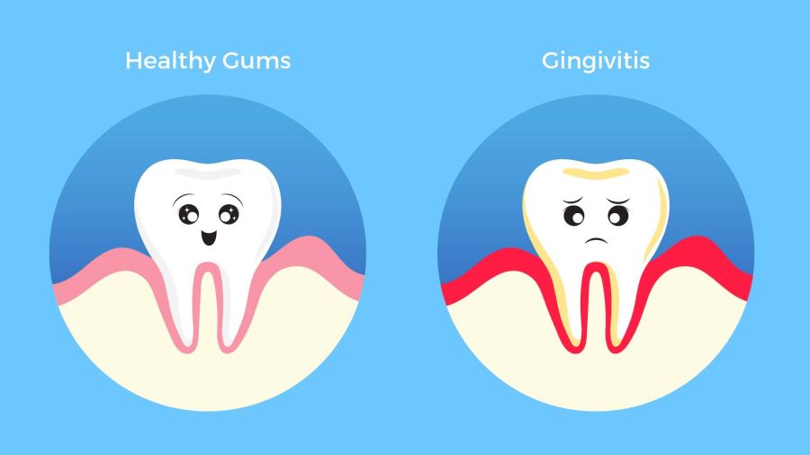Sângerarea gingiilor tratament in Timisoara