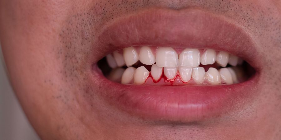 Sângerarea gingiilor tratament in Timisoara