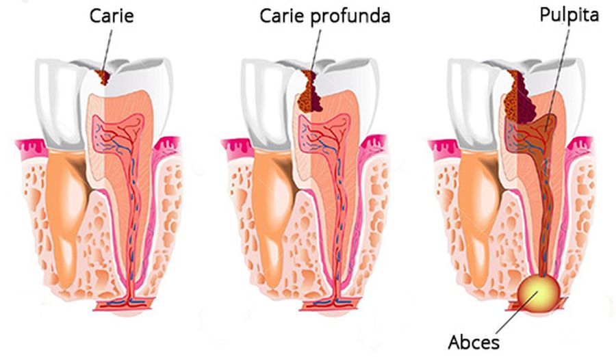 Abces dentar: Cauze și tratament Timisoara