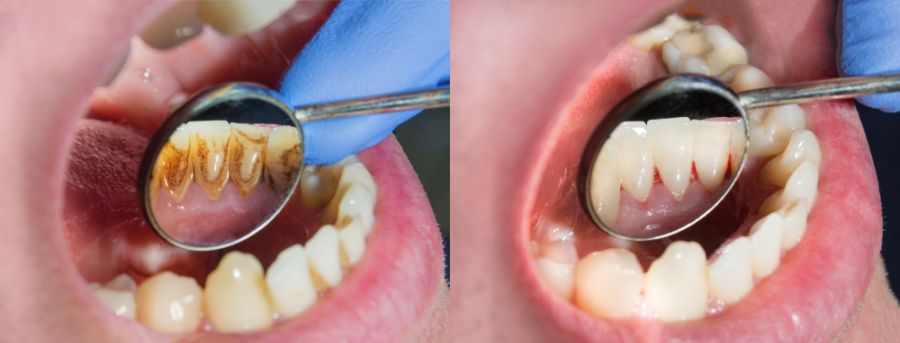 Tratamente de profilaxie dentară Timișoara