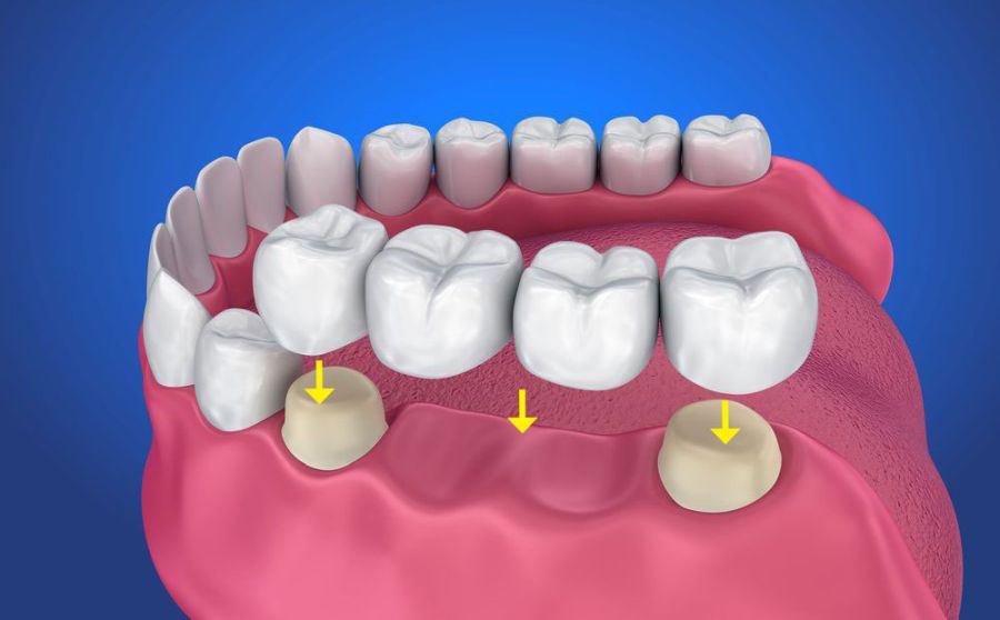 Coroane dentare: Când sunt necesare
