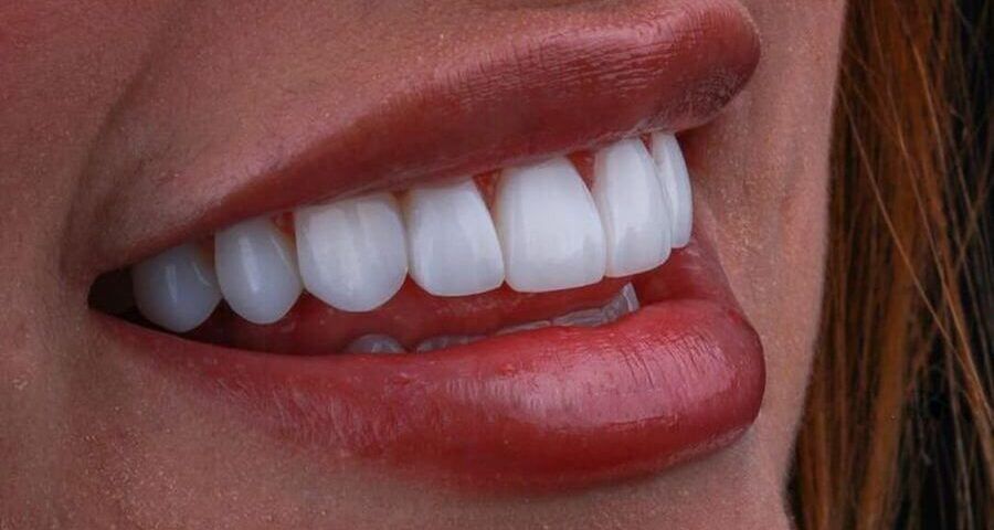 Coroane dentare: Când sunt necesare