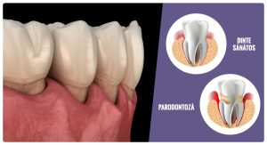 Cum poți opri evoluția bolii parodontale Timisoara