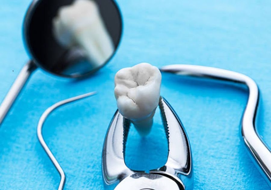 Extractii dentare in Timisoara