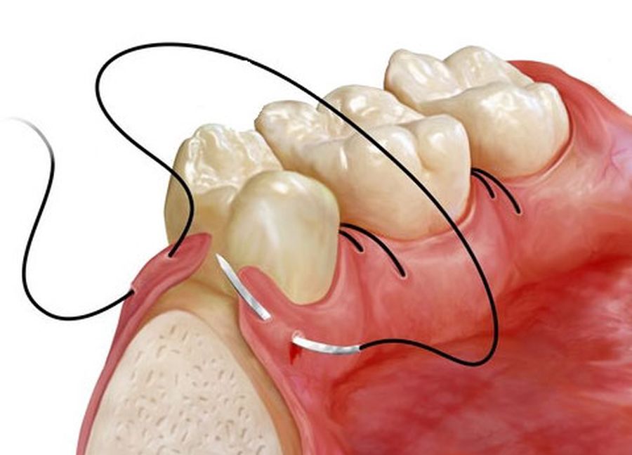 Extractii dentare in Timisoara