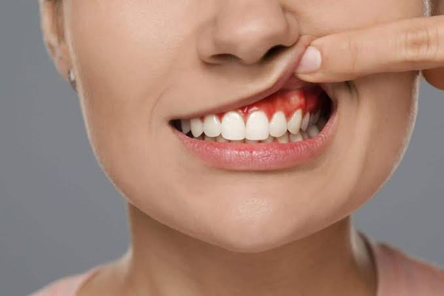 Diferența dintre gingivită și parodontită