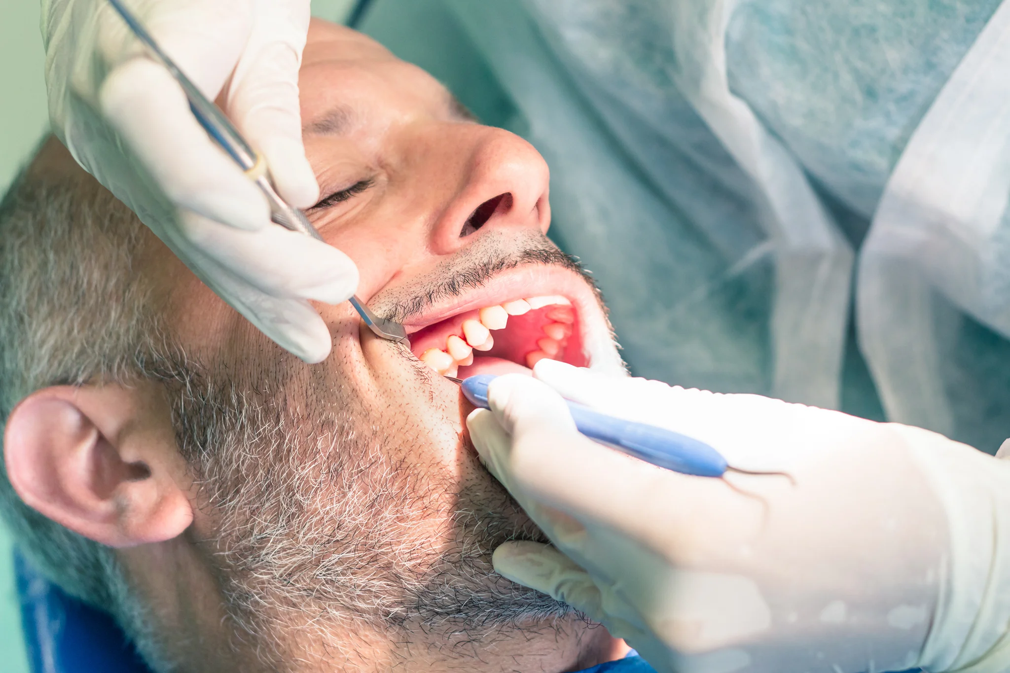 Diferența dintre gingivită și parodontită - tratament parodontoza Timisoara