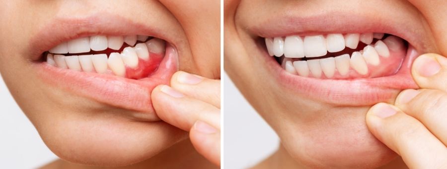 Diferența dintre gingivită și parodontită