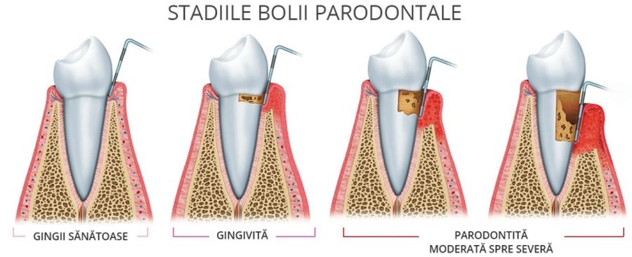 Diferența dintre gingivită și parodontită