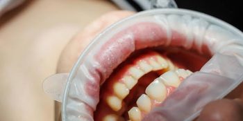 Detartrajul parodontal: Când este recomandat și cum te ajută să îți menții sănătatea gingiilor?