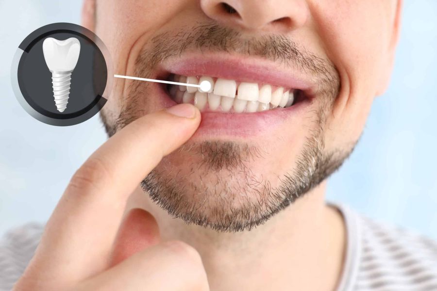 Implanturi dentare și dantura fixa Timișoara