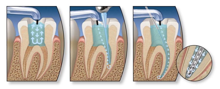 Tratamentul endodontic poate fi soluția